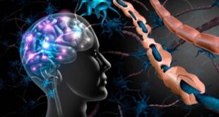 Inteligencia artificial identifica nuevos subtipos de esclerosis múltiple