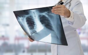 La IA mejora la detección de nódulos pulmonares en las radiografías de tórax