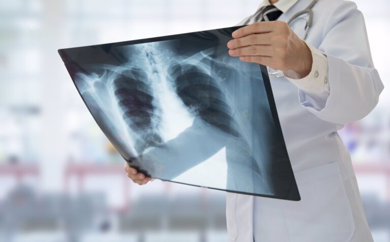 La IA mejora la detección de nódulos pulmonares en las radiografías de tórax