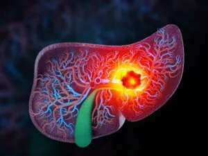 tumor-hepatico